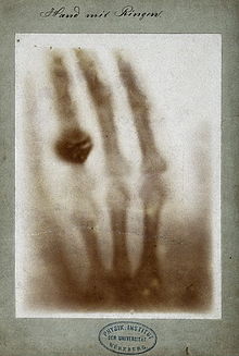Roentgen first x-ray Annas hand